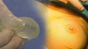 Francia: miles de mujeres afectadas por un fraude sin precedentes en los implantes mamarios