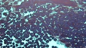 Cancer : découverte d’un marker biologique unique