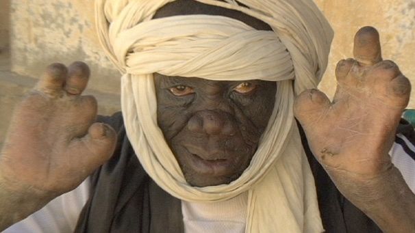 Leprosy – the forgotten disease