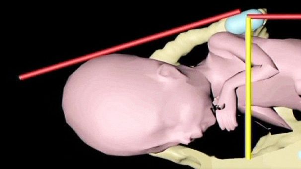 New imaging system may cut caesareans