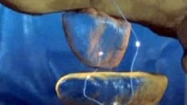 Gene therapy gives hope to Parkinson’s patients