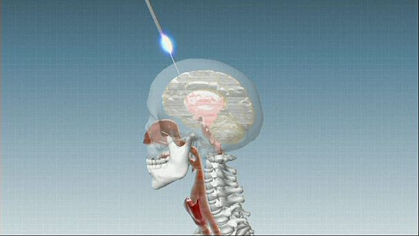 Encouraging progress in Parkinson’s therapy