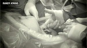 C-section baby gripping surgeon’s finger goes viral