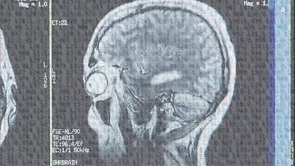 Coma software can accurately predict outcome
