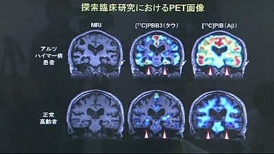 Japanese breakthrough in the Alzheimer’s mystery Japanese breakthrough in the Alzheimer’s mystery