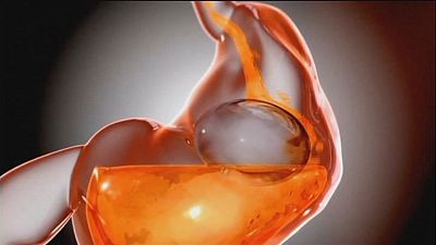 New balloon therapy to fight obesity New balloon therapy to fight obesity
