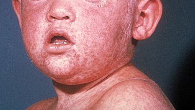 Measles outbreak in the US: Obama urges parents to vaccinate children Measles outbreak in the US: Obama urges parents to vaccinate children