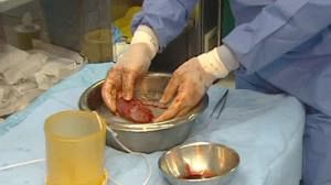 Reorganising, to meet Europe’s organ transplant needs