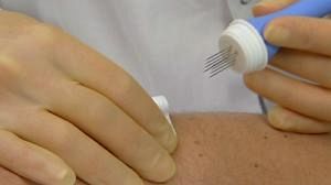 Electro-quimioterapia