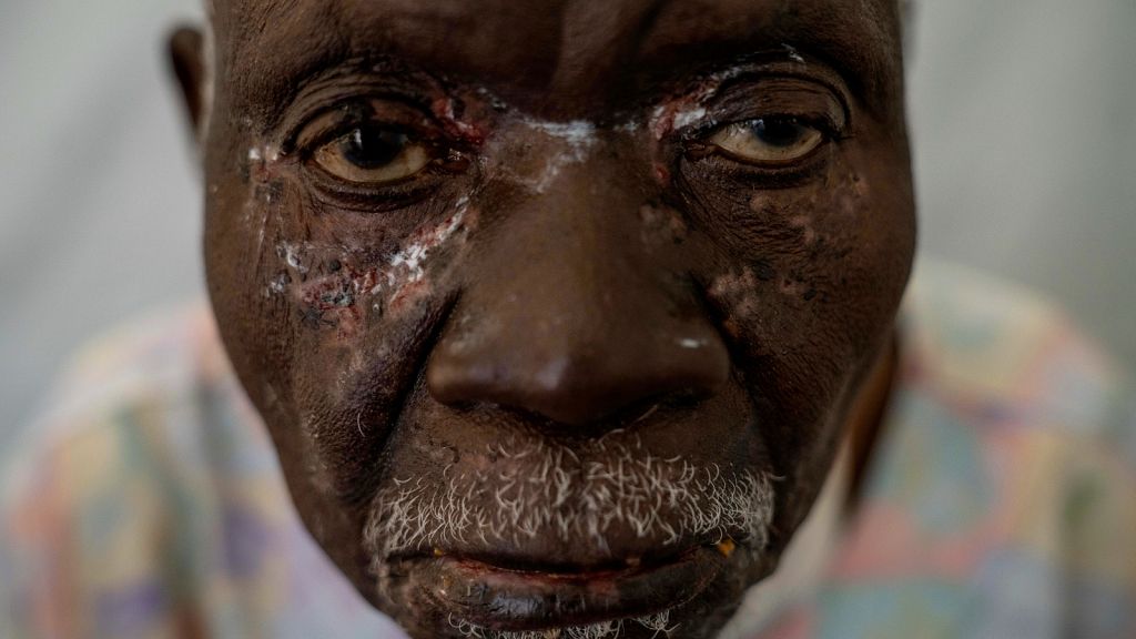 Mpox un photographe capture des clichés de l épidémie en Afrique