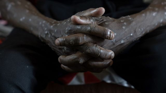 Mpox case found in Uganda penal complex, official says thumbnail