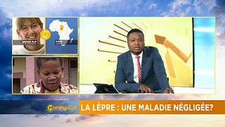 Leprosy re-emerges as global health challenge [The Morning Call]