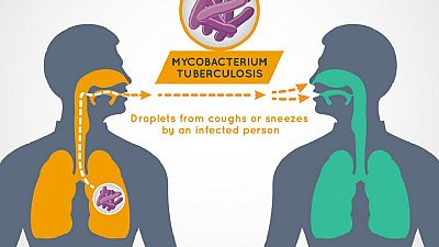 Experts fear covid-19 could set back Tuberculosis fight