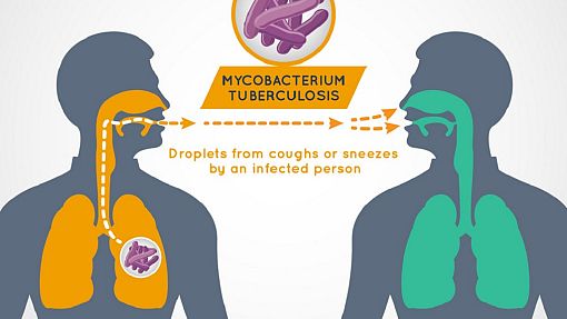 Experts fear covid-19 could set back Tuberculosis fight