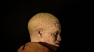 Burundi : le calvaire des albinos en saison sèche