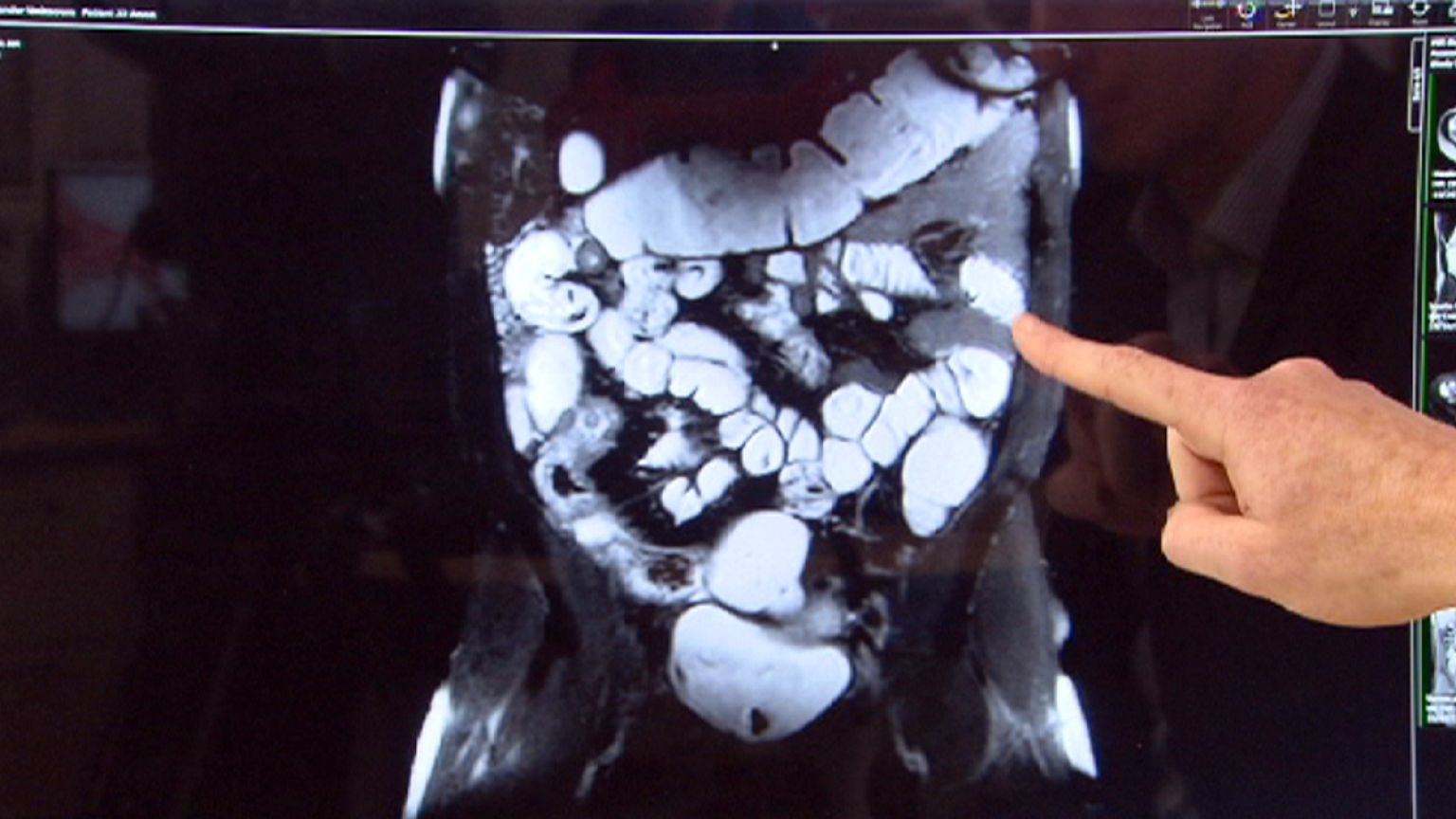 Η μάχη ενάντια στη νόσο του Crohn
