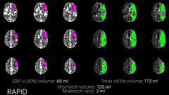 Image: Stroke CT perfusion scan