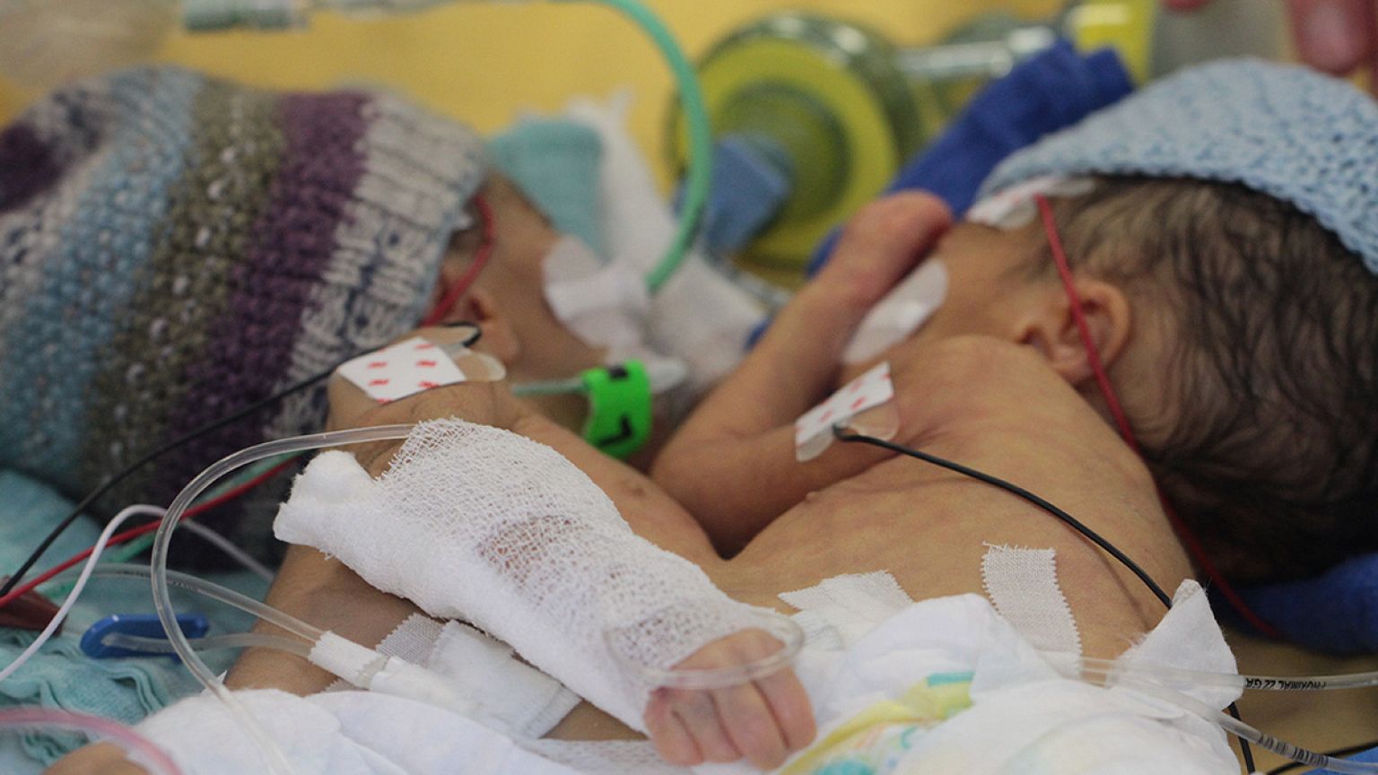Doctors separate 'smallest-ever' conjoined twins