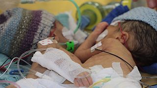 Doctors separate 'smallest-ever' conjoined twins