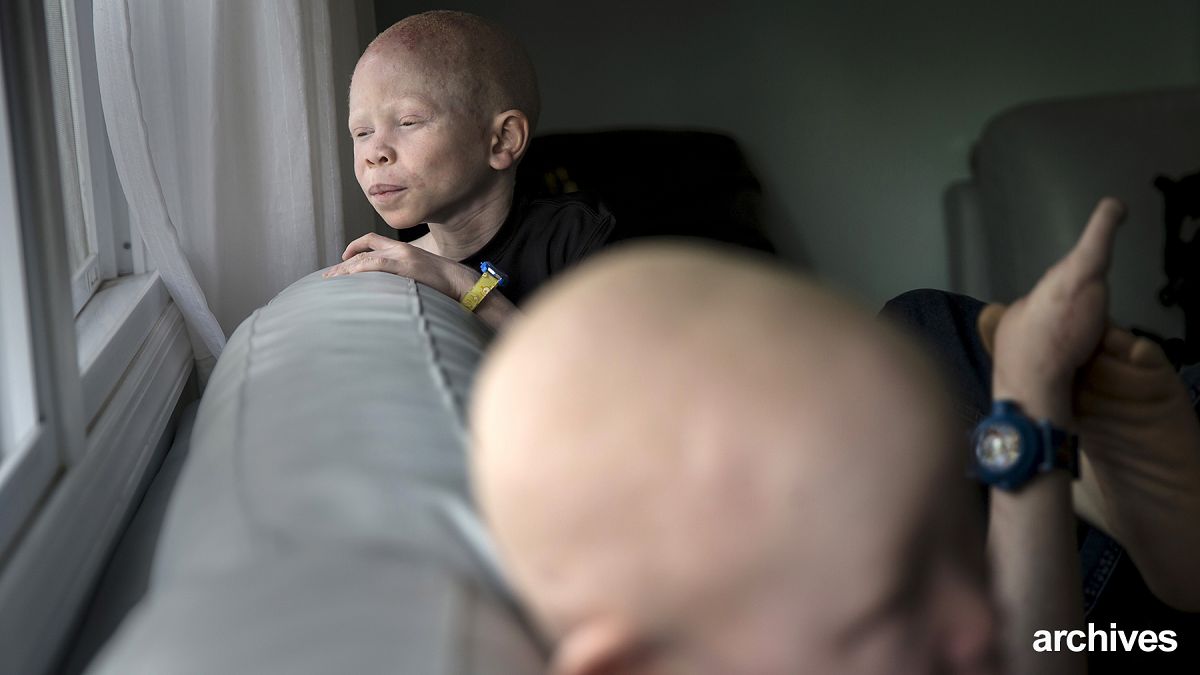 Malavi'de binlerce albino ölüm tehdidi altında