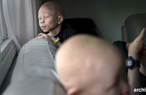 Malawi : les albinos menacés d'extermination