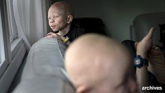 UN schlagen Alarm: Albinos in Malawi in Existenz bedroht