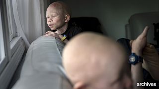 ООН посылает SOS: спасите альбиносов в Малави