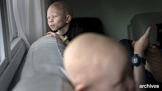 Los albinos podrían extinguirse en Malawi, según la ONU