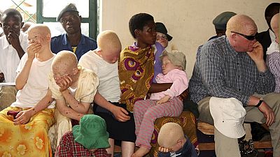 Endangered albinos in Malawi risk 'systematic extinction' - UN Expert