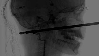An X-ray showing the meat skewer through Xavier Cunningham's face.