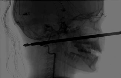 An X-ray showing the meat skewer through Xavier Cunningham\'s face.