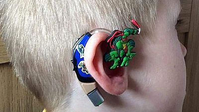 3D printed ear technology raising hopes of 2-year old girl