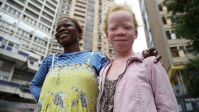 Malawi court bans traditional healers to avert albino killings