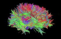 Beyin cerrahisinde hologram dönemi