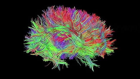 New 3D hologram allows Neurosurgeons to "walk through" our brains