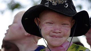 Afrique : union sacrée autour des albinos