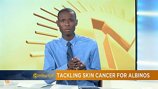 Senegalese sunscreens for albino [The Morning Call]