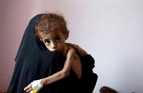 Image: A woman holds a malnourished boy at a hospital in Sanaa, Yemen