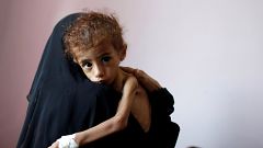 Image: A woman holds a malnourished boy at a hospital in Sanaa, Yemen