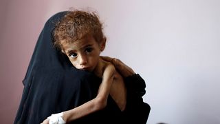 Image: A woman holds a malnourished boy at a hospital in Sanaa, Yemen