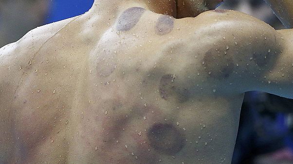 Michael Phelps schröpft sich zu Gold Michael Phelps schröpft sich zu Gold