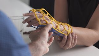 Bei Knochenbrüchen: 3D-Schiene statt Gips