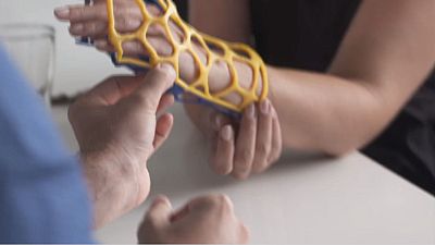Un plâtre futuriste en 3D pour soigner les fractures plus rapidement 