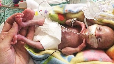 Baby Stensrud, believed to be the most premature surviving baby ever.