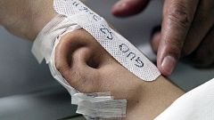 Θαύμα της πλαστικής χειρουργικής: Ανάπλαση αυτιού στο μπράτσο