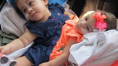 Twin girls conjoined at birth separated after two years