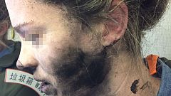 Headphone battery fire causes injury on China-Australia flight