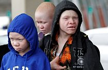 Four Tanzanian children with albinism in US for medical treatment