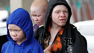 Four Tanzanian children with albinism in US for medical treatment