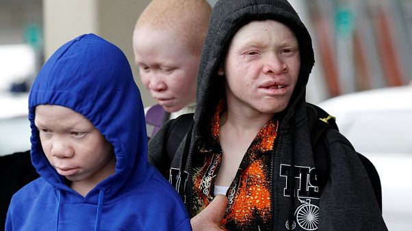 Four Tanzanian children with albinism in US for medical treatment Four Tanzanian children with albinism in US for medical treatment